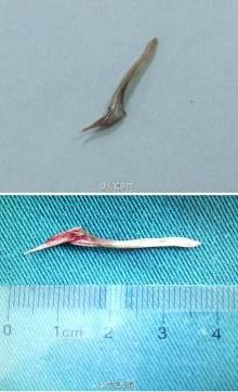 新闻 正文 大图 |小图 大图 |小图 【江苏男子吃饭"狼吞虎咽"竟致鱼刺