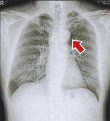 x光片有黑影 医师错把钮扣当肺癌患者心情大起伏(图)