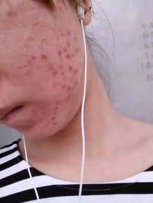 肌肤敏感要看,脸上红血丝必看,有痘有斑的更要