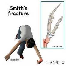 smith骨折:又称屈曲型桡骨远端骨折或反colles骨折,常由于跌倒时腕