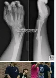 王俊凯打篮球手骨折 果然娘炮的世界我们不懂-新闻频道-手机搜狐