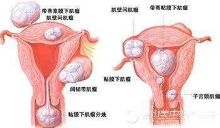<em>女性阴道</em>出血怎么回事?该怎么办?让我来告诉