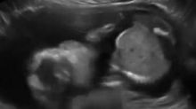 超级宝宝-- 子宫内胎儿自打脸 ,太不可思议了【1