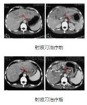 【专家解答】肝癌能治愈吗?射波刀能治好肝癌