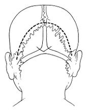 人字缝再造术 (1)于顶后(矢状缝后端)向两侧弧形切开头皮,皮瓣向枕部