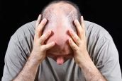 男人脱发背后的痛谁能懂?说出男人们的心声!【