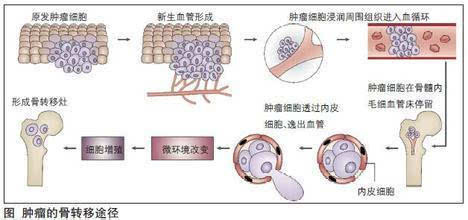 癌症骨转移