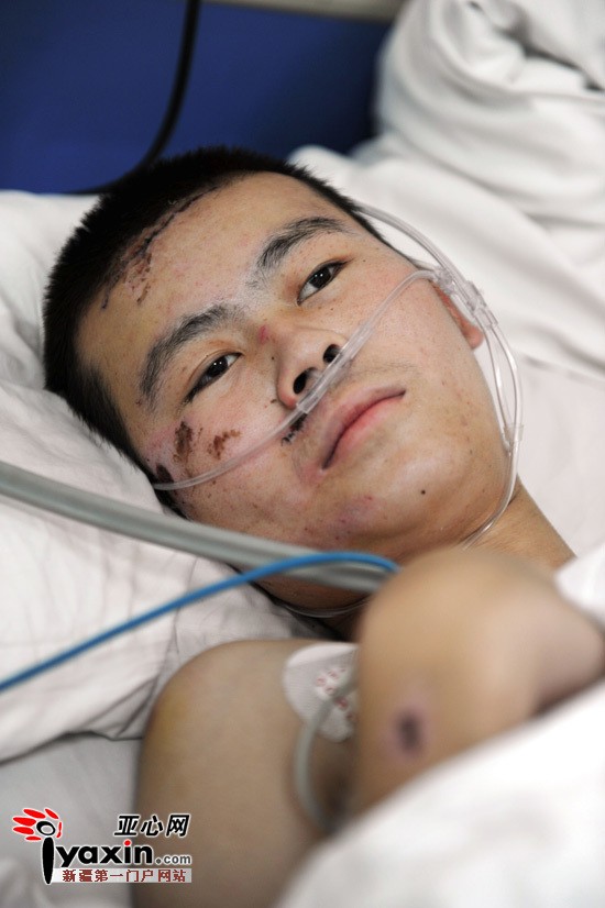 8月7日,自治区中医医院骨一科,被撞伤的男孩.